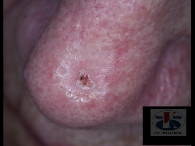 Sklerozuojanti (morphea) bazalioma