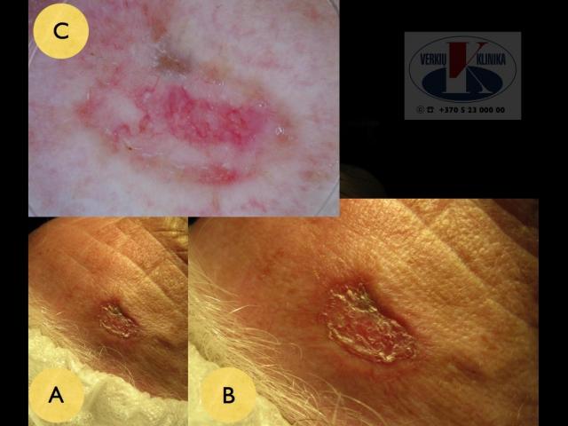 Sklerozuojanti (morphea) bazalioma