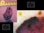 Paviršiumi plintanti  (radialinė) melanoma, A. Breslow 0,5 mm