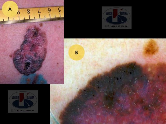 Paviršiumi plintanti  (radialinė) melanoma, A. Breslow 0,5 mm