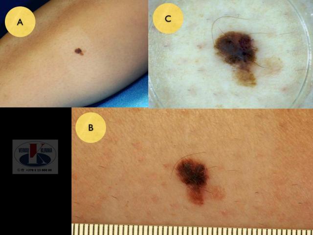 Paviršiumi plintanti  (radialinė) melanoma, A. Breslow 0,75 mm