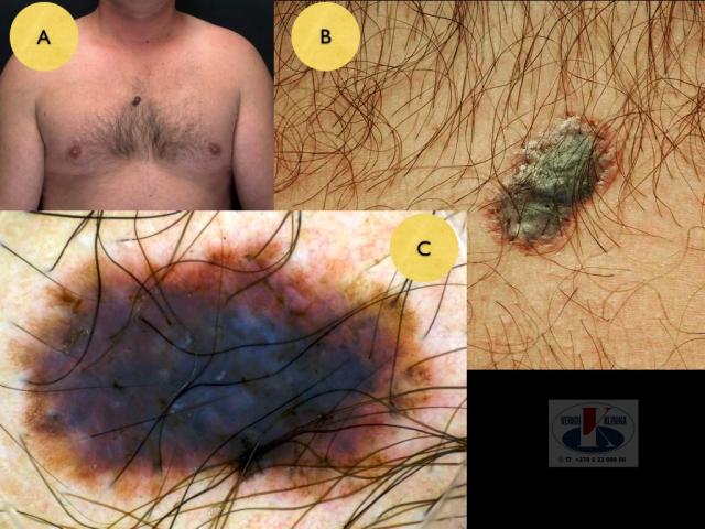 Paviršiumi plintanti  (radialinė) melanoma, A. Breslow 1,5 mm
