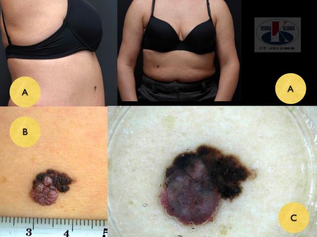 Paviršiumi plintanti (radialinė) melanoma, A. Breslow 1,2 mm
