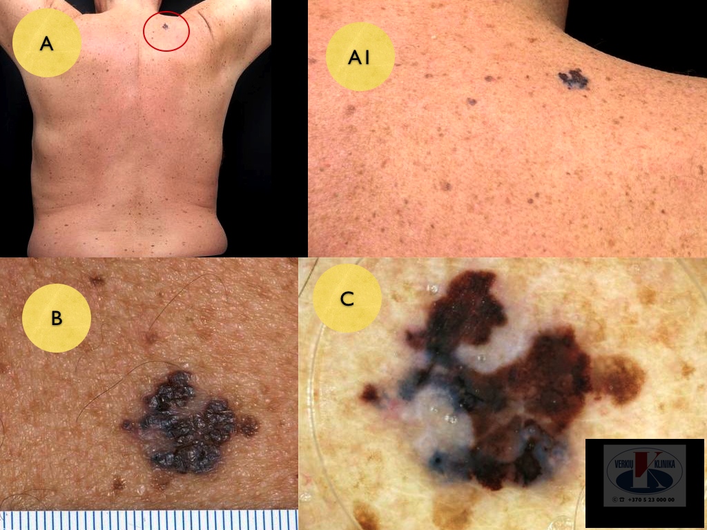 Paviršiumi plintanti  (radialinė) melanoma, A. Breslow 0,5 mm