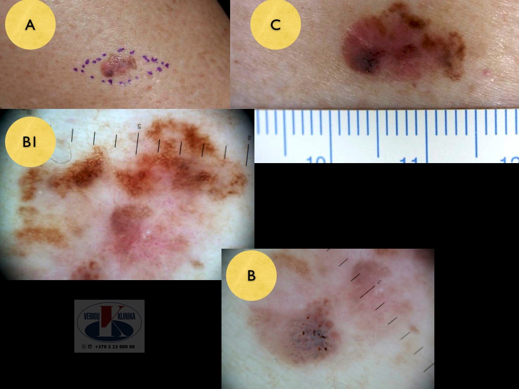 Paviršiumi plintanti (radialinė) melanoma, A. Breslow 0,5 mm