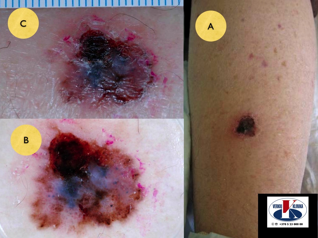 Paviršiumi plintanti   (radialinė) melanoma, A. Breslow 2,0 mm