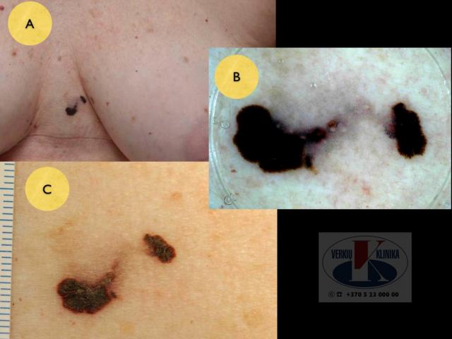 Paviršiumi plintanti (radialinė) melanoma, A. Breslow: melanoma in situ (Tis)