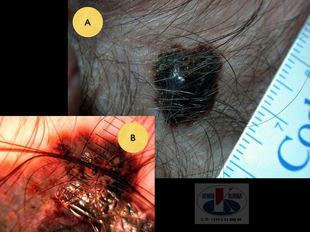 Mazginė melanoma, A. Breslow 2,8 mm