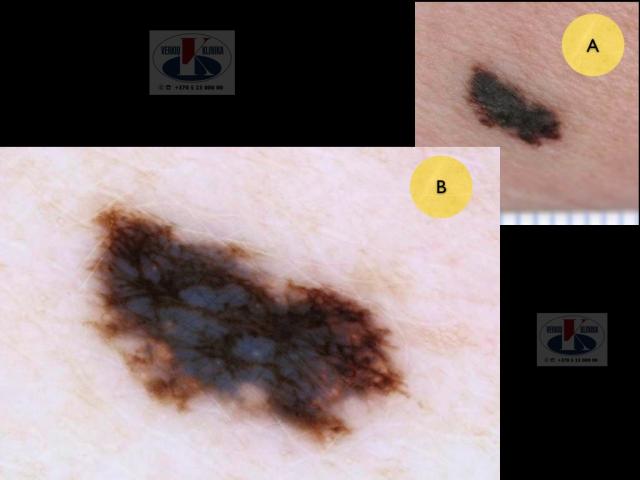 Paviršiumi plintanti   (radialinė) melanoma, A. Breslow 0,7 mm