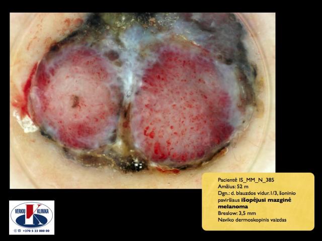  Išopėjusi mazginė melanoma, A. Breslow 3,5 mm