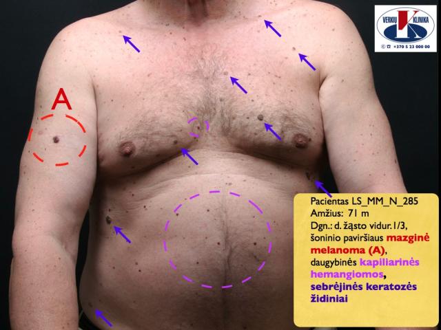 Mazginė melanoma