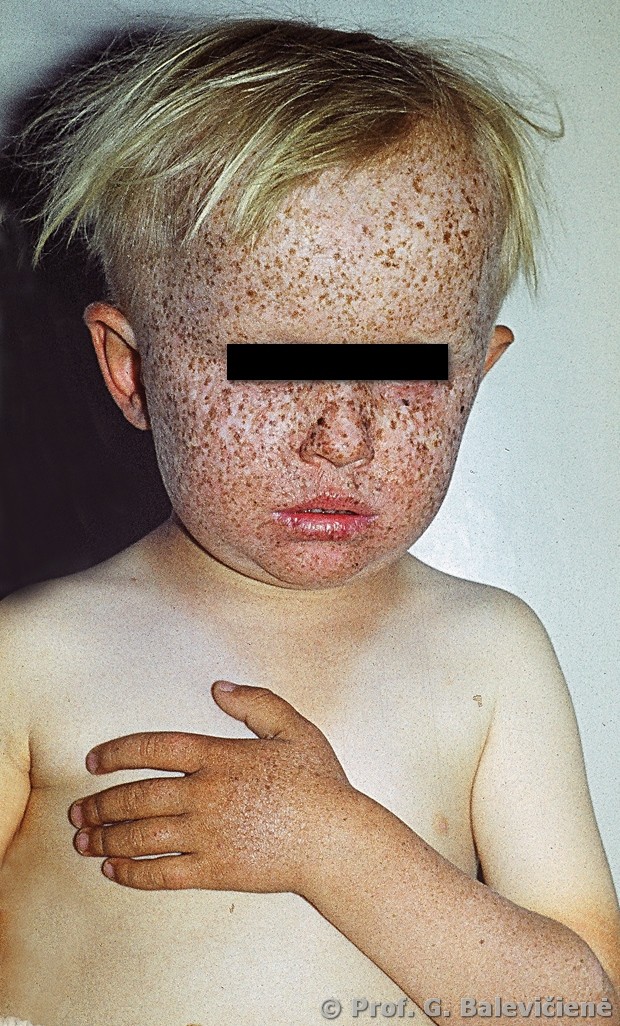 Pigmentinė kseroderma