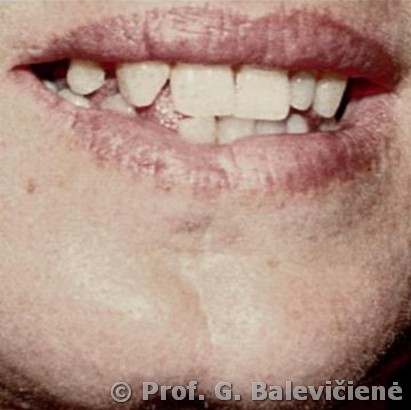 Sclerodermia ictus gladii