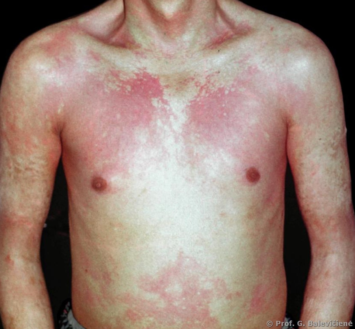 Sclerodermia diffusa
