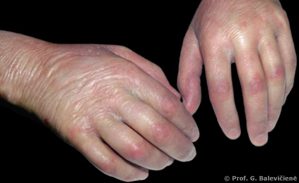 Sclerodermia diffusa