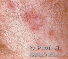 Diuringo pūslelinis dermatitas 