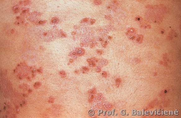 Diuringo pūslelinis dermatitas 