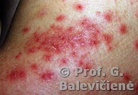Diuringo pūslelinis dermatitas 