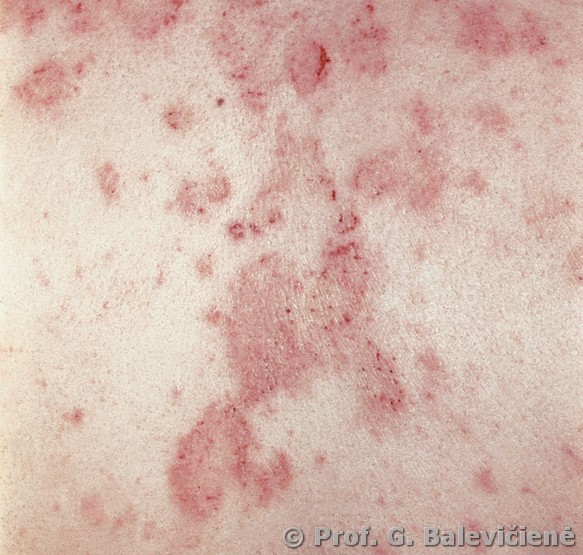 Diuringo pūslelinis dermatitas 