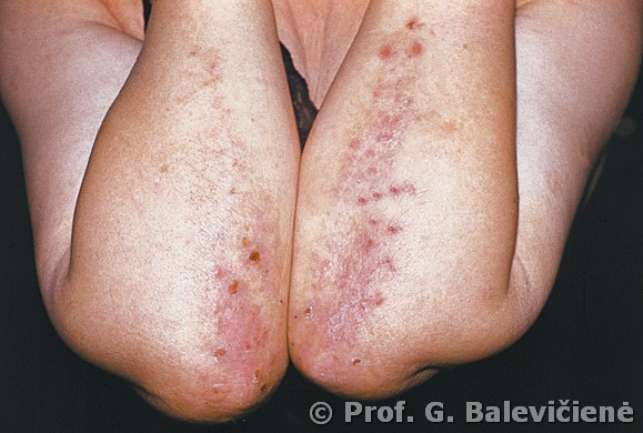 Diuringo pūslelinis dermatitas 
