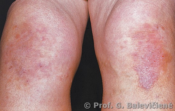 Diuringo pūslelinis dermatitas 