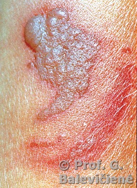 Alerginis kontaktinis dermatitas