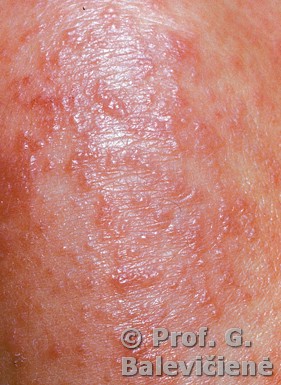 Alerginis kontaktinis dermatitas