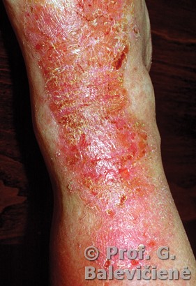 Alerginis kontaktinis dermatitas