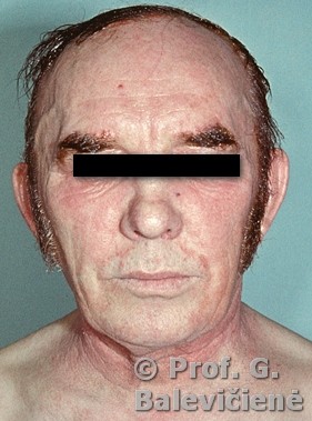 Alerginis kontaktinis dermatitas