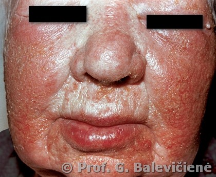 Alerginis kontaktinis dermatitas