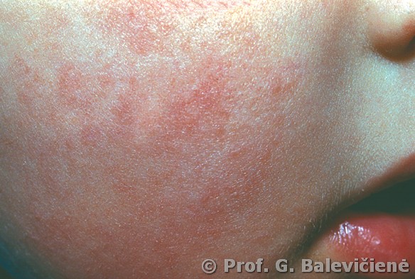 Atopinis dermatitas