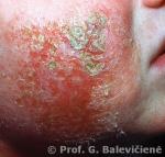 Atopinis dermatitas