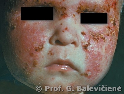 Atopinis dermatitas