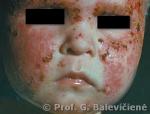 Atopinis dermatitas