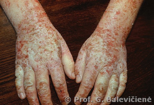 Atopinis dermatitas