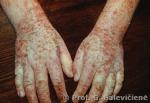 Atopinis dermatitas