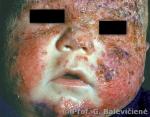 Atopinis dermatitas