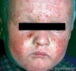 Atopinis dermatitas