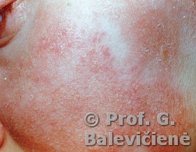 Atopinis dermatitas