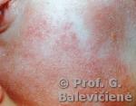 Atopinis dermatitas