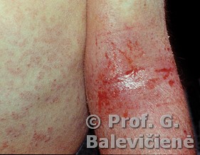 Atopinis dermatitas