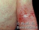 Atopinis dermatitas