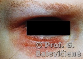 Atopinis dermatitas. Dennie-Morgan raukšlė 