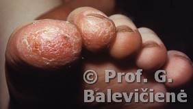 Atopinis dermatitas