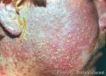 Impetiginizuota egzema