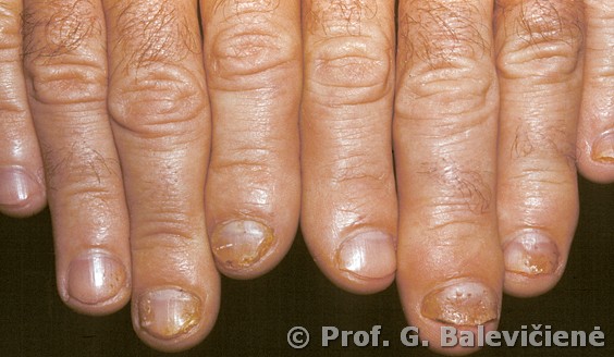 Psoriazinis artritas   