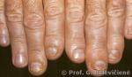 Psoriazinis artritas   