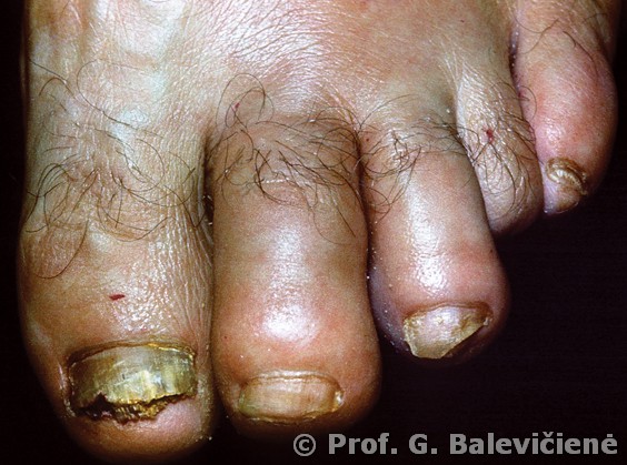 Psoriazinis artritas   
