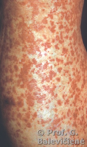 Alerginis vaskulitas
