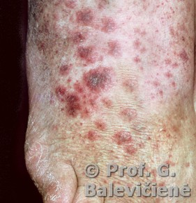 Alerginis vaskulitas